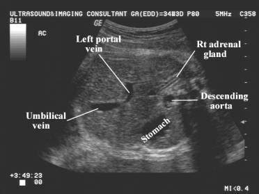 Umbilical Vein Ultrasound