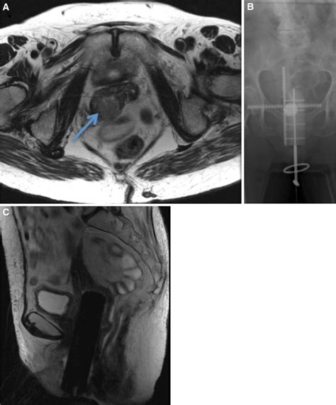 A Axial T2 Weighted Mri Shows Recurrent Squamous Cell Carcinoma