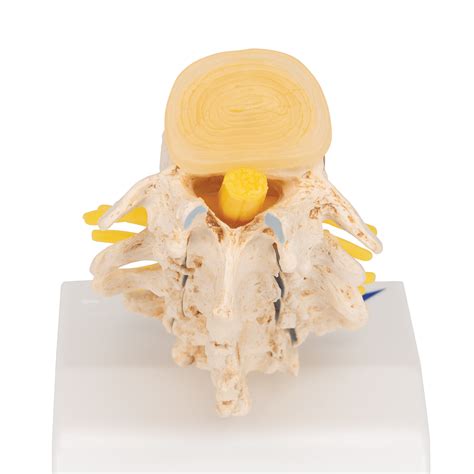 Anatomical Teaching Models Plastic Vertebrae Model Disc Prolapse Model