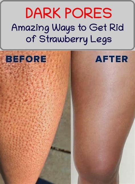 How To Finally Get Rid Of Strawberry Legs In Strawberry Legs