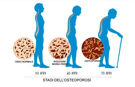 Il Protocollo Per Prevenire L Osteoporosi CellWellbeing Italia