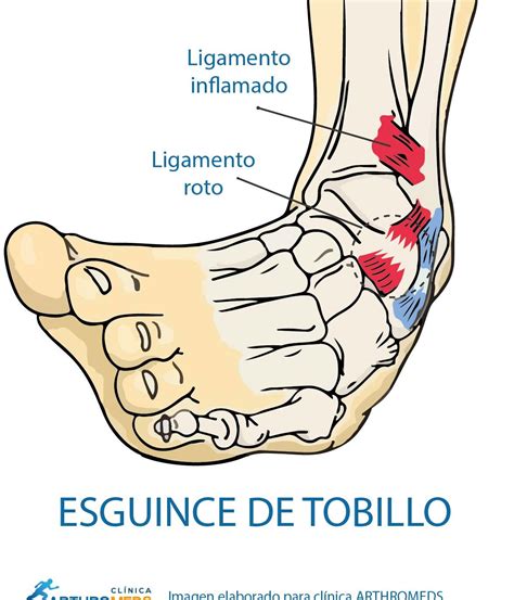 Esguince De Tobillo Y Fisura Descubre C Mo Aliviar El Dolor Y La