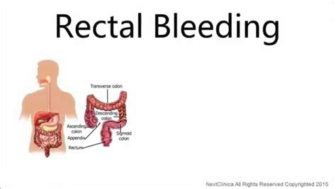 Rectal Bleeding Pictures