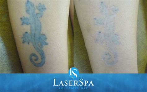 Laser Tattoo Removal Laserspa Of Tampa Bay