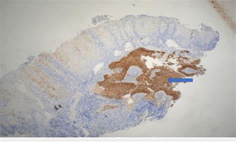 Immunohistochemistry By P16 Shows Diffuse Nuclear And Cytoplasmic