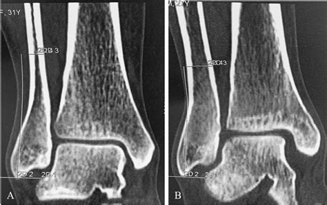 Examples Of Different Distal Fibula Morphologies A Coronal Ct Of A