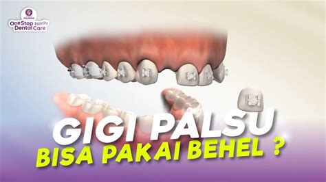 GIGI PALSU BISA DIPASANG BEHEL YUK KITA CARI TAHU JAWABANNYA YouTube