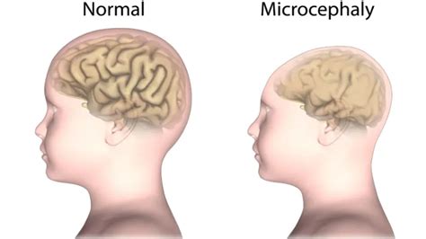 Anencephaly: Causes, Symptoms, Diagnosis and Management