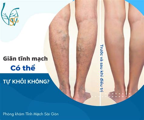 Bệnh Giãn Tĩnh Mạch Có Chữa Được Không Phương Pháp Điều Trị Hiệu Quả