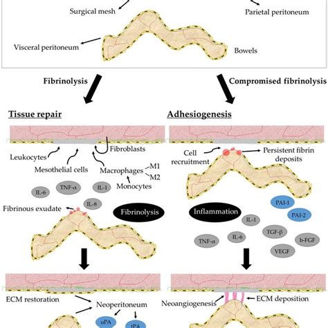 Diagram Showing The Two Possible Pathways After Peritoneal Injury