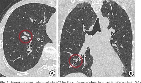 Figure 1 From Mucus Plugs And Small Airway Dysfunction In Asthma Copd