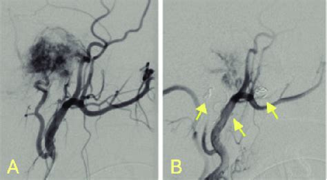 DSA Of The Left External Carotid Artery On Lateral Projection Showed