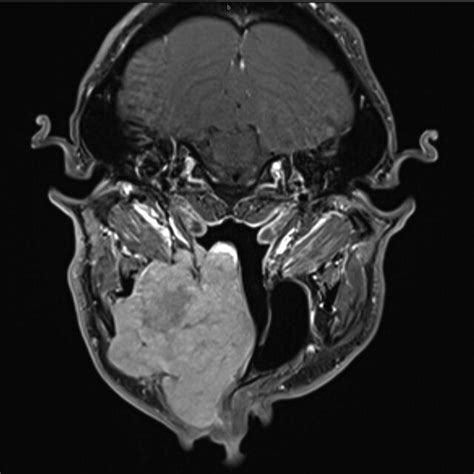 Preoperative Magnetic Resonance Imaging Mri Axial View T Weighted