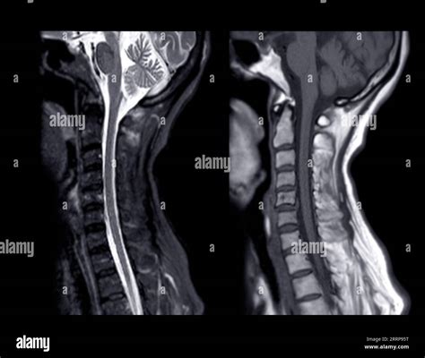 Rm De La Columna Cervical O Imagen De Resonancia Magnética De La Vista Sagital De La Columna