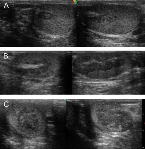 Testicular Ultrasonography In Patients Showing Tart Location Around