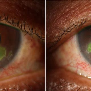 Neurotrophic Corneal Ulcers In The Right Eye A And Left Eye B