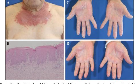 Figure From Pembrolizumab Induced Psoriasis Vulgaris Successfully