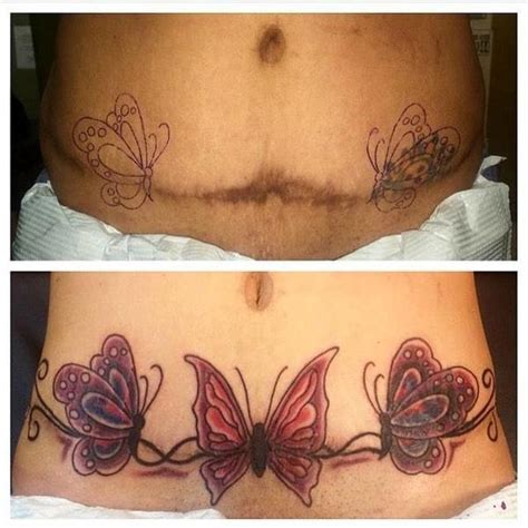 Tummy Tuck Tattoo Cover Ups Pictures 23 Tummy Tuck Prices Photos