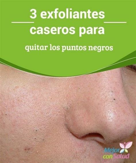 Remedios Caseros Para Los Puntos Negros Soluciones Artofit