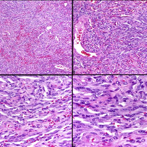 Kaposi Sarcoma A Low Power View Showing A Lesion Composed Of