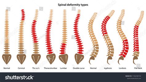 Vektor Stok Spinal Deformity Types Diagram Marked Sections Tanpa