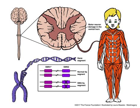 Spinal Muscle Atrophy 6colored Small Medical Illustrations