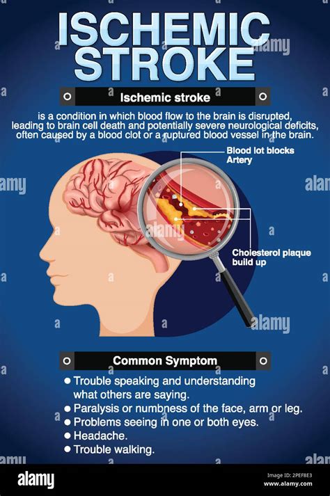 Informative Poster Of Ischemic Stroke Illustration Stock Vector Image