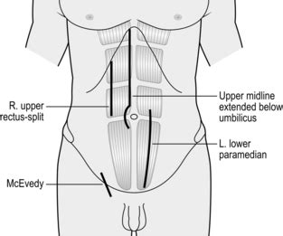 Laparotomy: elective and emergency | Basicmedical Key