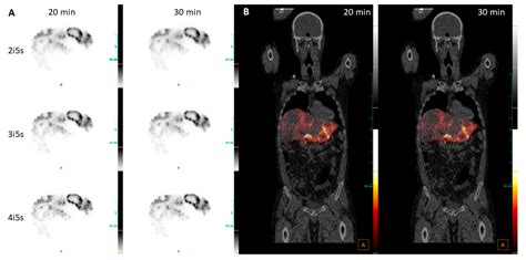 Diagnostics Free Full Text Optimization Of Y Radioembolization