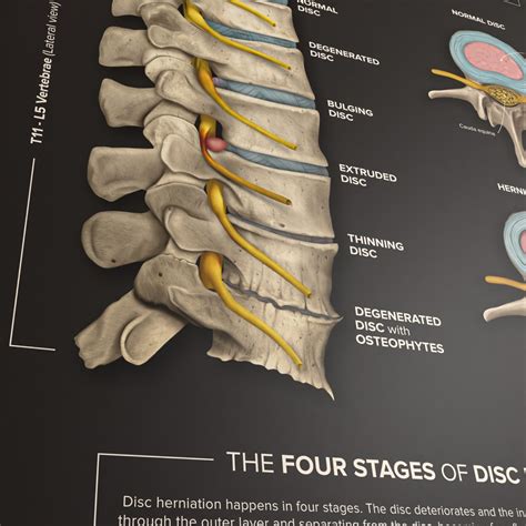 Intervertebral Disc Degeneration poster - Kirografiks