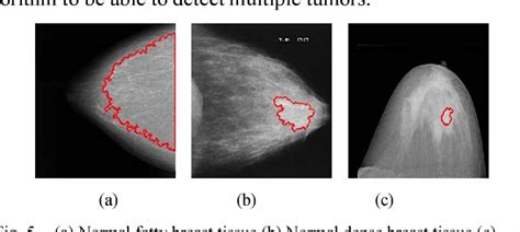 Figure 3 From Segmentation Of Breast Cancer Lesion In Digitized