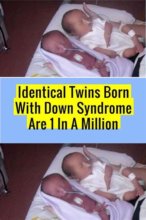 Mom Gives Birth To Identical Twins Then Doctor Says I M Sorry As The Twins Have Down Syndrome