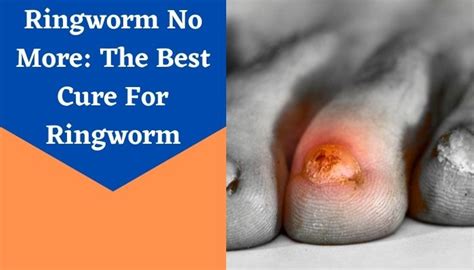 How To Get Rid Of Ringworm In Humans