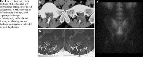 A Ct Showing Typical Findings Of Discitis After Left Interlaminar