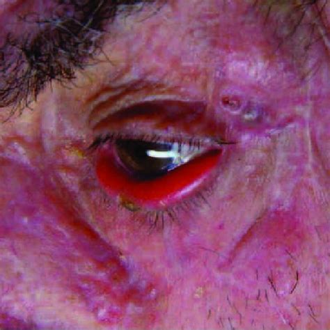 Ectropion And Tumor Lesion On Free Edge Of Lower Eyelid Of Left Eye