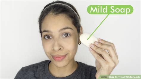 3 Ways To Treat Whiteheads Wikihow