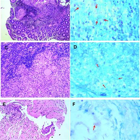 Hematoxylin And Eosin Stain Hande Of Biopsy Specimens A Intestinal