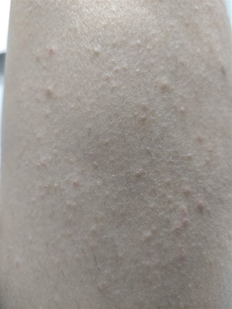 Is This An Hiv Rash Appeared 1 Month After Sex With Stranger It Was Insertive Vaginal Sex With