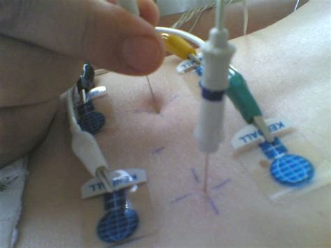 How Much Does EMG Test Cost In 2024?