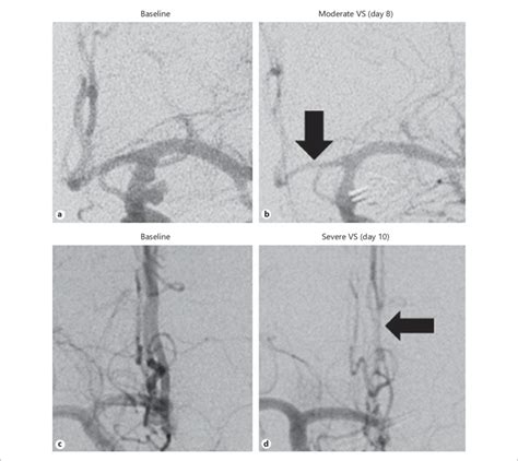 Digital Subtraction Angiography Images Taken Before And After The