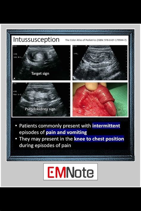 Intussusception Youtube