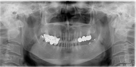 Characteristic Features Of Fungus Ball In The Maxillary Sinus And The