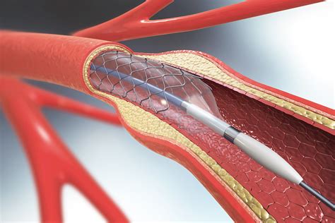 Heart Stent Recovery Time All To Know Carda Health