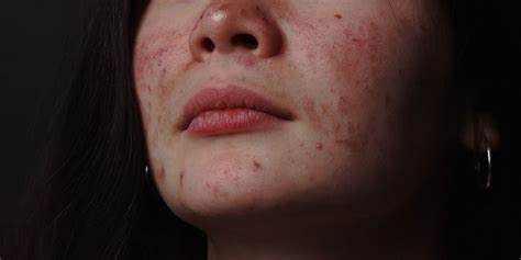 Kenali Apa Itu Rosacea Ciri Ciri Penyebab Cara Mengobatinya