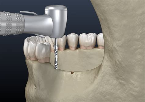 When Does A Smile Need Jawbone Grafting Conroe Tx