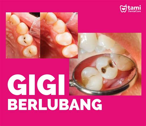 Gigi Berlubang Tami Dental Care Klinik Dokter Gigi Bandung Bojongsoang Cimahi Antapani Sarijadi