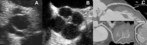 Figure 1 From Quadricuspid Aortic Valve Defined By Echocardiography And