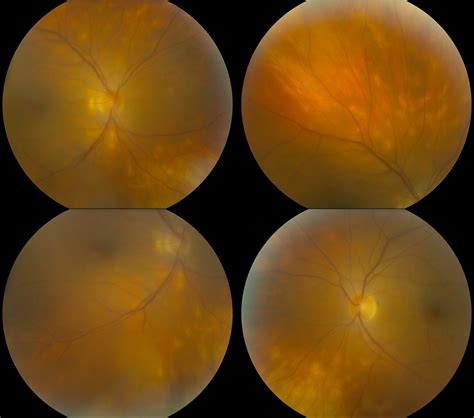 Birdshot Chorioretinopathy