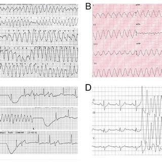 Typical ECG before treatment with a temporary pacemaker from different... | Download Scientific ...