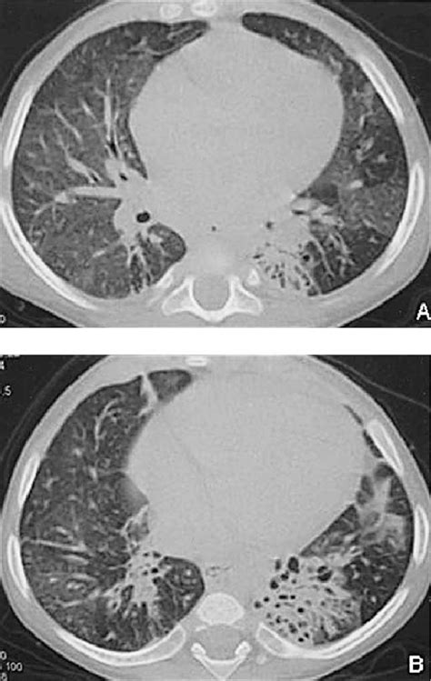 A And B Hrct Appearances Of 2 Year Old Girl With Cystic Fibrosis Download Scientific Diagram